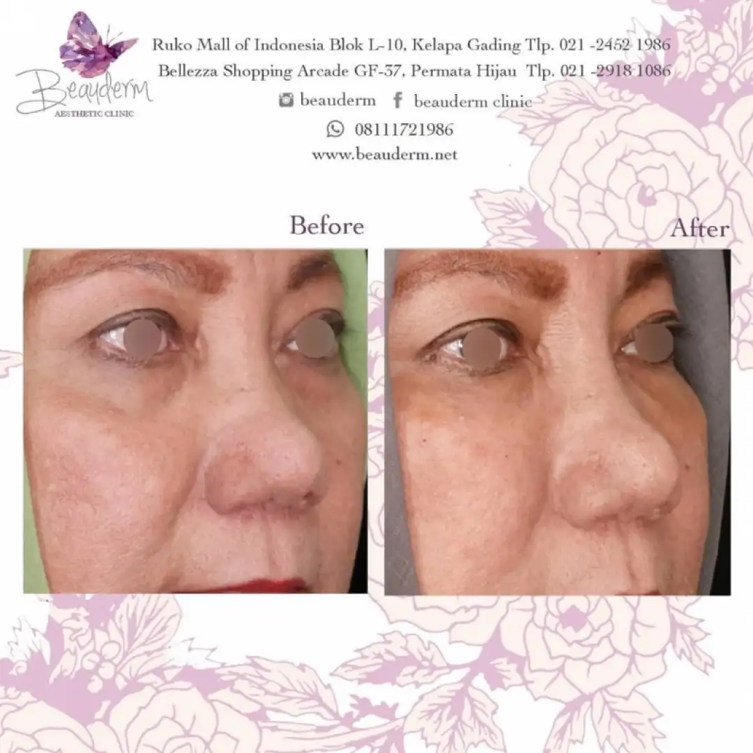 Under Eye Filler